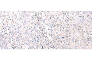 Immunohistochemistry of paraffin-embedded Human cervical cancer tissue using HLA-C Polyclonal Antibody at dilution of 1:25(x200) (HLA-C 抗体)