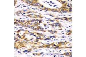 Immunohistochemistry of paraffin-embedded human gastric cancer using RPN1 antibody. (RPN1 抗体  (AA 20-280))