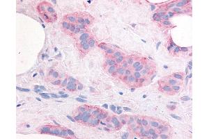 Anti-KDR / VEGFR2 antibody IHC of human Breast, Carcinoma. (VEGFR2/CD309 抗体  (Internal Region))