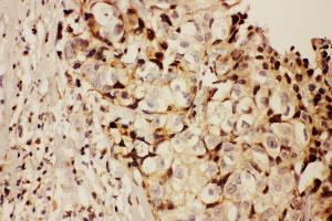 Anti-RFC1 antibody, IHC(P) IHC(P): Human Mammary Cancer Tissue (RFC1 抗体  (N-Term))