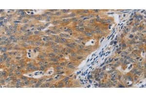 Immunohistochemistry of paraffin-embedded Human ovarian cancer using F2R Polyclonal Antibody at dilution of 1:40 (PAR1 抗体)