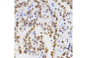Immunohistochemistry of paraffin-embedded human thyroid cancer using DiMethyl-Histone H3-K9 antibody. (Histone 3 抗体  (H3K9me2))