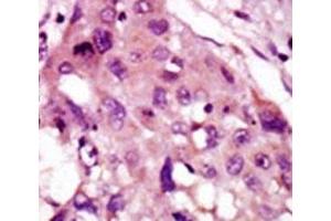 IHC analysis of FFPE human hepatocarcinoma tissue stained with the IRAK2 antibody (IRAK2 抗体  (AA 549-581))