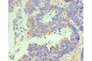 Immunohistochemistry of paraffin-embedded human ovarian cancer using ABIN7164069 at dilution of 1:100 (OCT4 抗体  (AA 1-360))