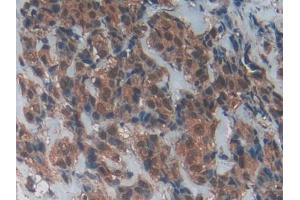 DAB staining on IHC-P; Samples: Human Breast cancer Tissue (CD40 Ligand 抗体  (AA 180-261))