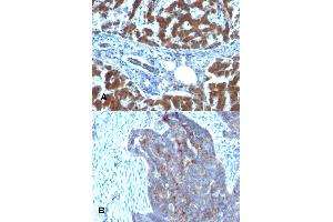 Immunohistochemical staining (Formalin-fixed paraffin-embedded sections) of (A) human hepatocellular carcinoma and (B) human ovarian carcinoma with RBP1 monoclonal antibody, clone RBP/872 . (RBP1 抗体)