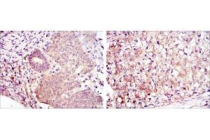 Immunohistochemical analysis of paraffin-embedded ovarian cancer (left) and kidney cancer (right) using MAP2K6 mouse mAb with DAB staining. (MAP2K6 抗体)