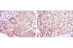 Immunohistochemical analysis of paraffin-embedded ovarian cancer (left) and kidney cancer (right) using MAP2K6 mouse mAb with DAB staining.