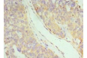 Immunohistochemistry of paraffin-embedded human endometrial cancer using ABIN7156580 at dilution of 1:100 (IFNAR2 抗体  (AA 27-243))