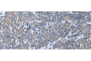 Immunohistochemistry of paraffin-embedded Human thyroid cancer tissue using UBAC2 Polyclonal Antibody at dilution of 1:50(x200) (UBAC2 抗体)