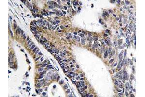 Immunohistochemical analysis of paraffin-embedded human colon cancer tissue using IQCB1 polyclonal antibody . (IQCB1 抗体)