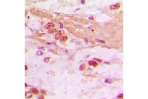 Immunohistochemical analysis of TSC22 staining in human lung cancer formalin fixed paraffin embedded tissue section. (TSC22D1 抗体  (C-Term))