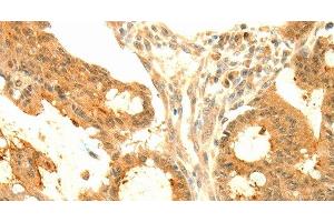 Immunohistochemistry of paraffin-embedded Human colon cancer tissue using SOCS6 Polyclonal Antibody at dilution 1:50 (SOCS6 抗体)