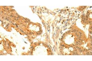 Immunohistochemistry of paraffin-embedded Human colon cancer tissue using SOCS6 Polyclonal Antibody at dilution 1:50