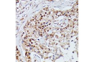 Immunohistochemistry of paraffin-embedded human mammary cancer using IGHMBP2 antibody (ABIN7267848) at dilution of 1:100 (40x lens). (IGHMBP2 抗体  (AA 540-720))