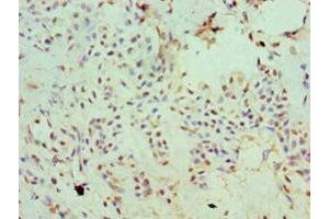 Immunohistochemistry of paraffin-embedded human breast cancer using ABIN7170006 at dilution of 1:100 (SLC2A2 抗体  (AA 235-485))