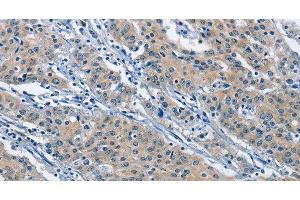 Immunohistochemistry of paraffin-embedded Human gastric cancer using KLF7 Polyclonal Antibody at dilution of 1:60 (KLF7 抗体)