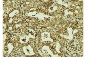 ABIN6273244 at 1/100 staining Human breast cancer tissue by IHC-P. (FBXW7 抗体)