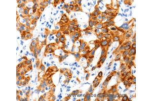 Immunohistochemistry of Human cervical cancer using SLC2A11 Polyclonal Antibody at dilution of 1:140 (SLC2A11 抗体)