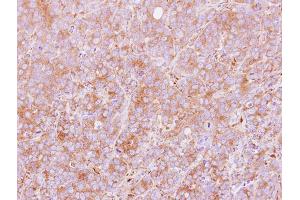 IHC-P Image Immunohistochemical analysis of paraffin-embedded MCF7 xenograft, using PDIR, antibody at 1:100 dilution.