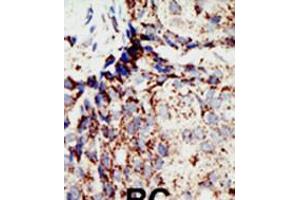 Formalin-fixed and paraffin-embedded human cancer tissue reacted with the primary antibody, which was peroxidase-conjugated to the secondary antibody, followed by DAB staining. (BAP1 抗体  (N-Term))