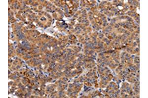 The image on the left is immunohistochemistry of paraffin-embedded Human thyroid cancer tissue using ABIN7130361(NDUFA1 Antibody) at dilution 1/70, on the right is treated with fusion protein. (NDUFA1 抗体)