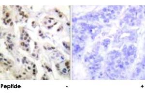 Immunohistochemical analysis of paraffin-embedded human breast carcinoma tissue using LMNA polyclonal antibody . (Lamin A/C 抗体)