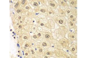 Immunohistochemistry of paraffin-embedded Human liver damage using PSMD2 Polyclonal Antibody at dilution of 1:100 (40x lens). (PSMD2 抗体)