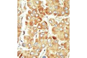 Formalin-fixed and paraffin-embedded human cancer tissue reacted with the primary antibody, which was peroxidase-conjugated to the secondary antibody, followed by DAB staining. (SRPK1 抗体  (N-Term))
