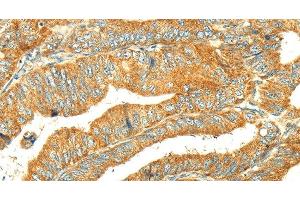 Immunohistochemistry of paraffin-embedded Human colon cancer tissue using GK1 Polyclonal Antibody at dilution 1:60 (Glycerol Kinase 抗体)