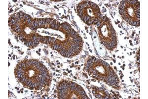 IHC-P Image Immunohistochemical analysis of paraffin-embedded human colon carcinoma, using MEK2, antibody at 1:500 dilution. (MEK2 抗体)