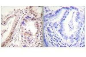 Immunohistochemistry analysis of paraffin-embedded human lung carcinoma tissue using Estrogen Receptor-α (Ab-537) antibody.