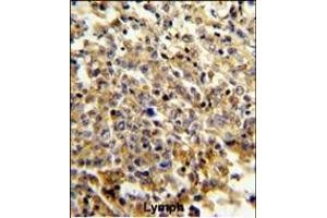 Formalin-fixed and paraffin-embedded human lymphoma reacted with NCF4 Antibody (C-term), which was peroxidase-conjugated to the secondary antibody, followed by DAB staining. (NCF4 抗体  (C-Term))