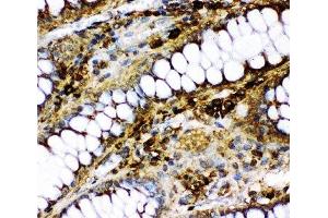 IHC-P: p73 antibody testing of human intestinal cancer tissue (Tumor Protein p73 抗体  (AA 1-198))