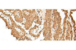 Immunohistochemistry of paraffin-embedded Human thyroid cancer tissue using VPS50 Polyclonal Antibody at dilution of 1:45(x200) (Syndetin/VPS50 抗体)