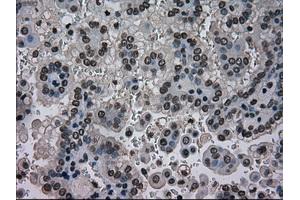 Immunohistochemical staining of paraffin-embedded Carcinoma of kidney tissue using anti-NRBP1mouse monoclonal antibody. (NRBP1 抗体)