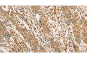 Immunohistochemistry of paraffin-embedded Human gastric cancer using CPB1 Polyclonal Antibody at dilution of 1:60 (CPB1 抗体)