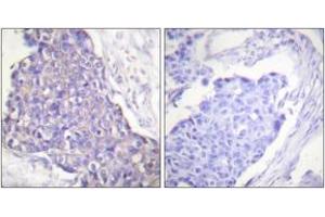 Immunohistochemistry analysis of paraffin-embedded human breast carcinoma tissue, using CD40 Antibody. (CD40 抗体  (AA 228-277))