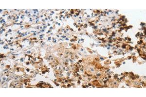 Immunohistochemistry of paraffin-embedded Human cervical cancer using LCN2 Polyclonal Antibody at dilution of 1:60 (Lipocalin 2 抗体)