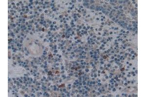 Detection of HO1 in Human Skin cancer Tissue using Polyclonal Antibody to Heme Oxygenase 1 (HO1) (HMOX1 抗体  (AA 61-172))