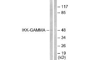 Immunohistochemical analysis of paraffin-embedded human lung carcinoma tissue using IKK-γ (Ab-31) Antibody.