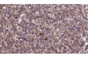 ABIN6276846 at 1/100 staining Human liver cancer tissue by IHC-P. (GABRG2 抗体  (N-Term))