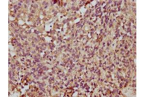 IHC image of ABIN7173067 diluted at 1:350 and staining in paraffin-embedded human ovarian cancer performed on a Leica BondTM system. (TMEM14A 抗体  (AA 45-78))