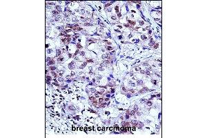 HIST1H1D Antibody (Center) (ABIN657667 and ABIN2846660) immunohistochemistry analysis in formalin fixed and paraffin embedded human breast carcinoma followed by peroxidase conjugation of the secondary antibody and DAB staining. (Histone H1.3 抗体  (AA 135-164))
