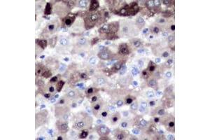 Immunohistochemical analysis of XPO2 staining in human liver cancer formalin fixed paraffin embedded tissue section. (Exportin 2 抗体  (N-Term))