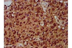 IHC image of ABIN7170618 diluted at 1:200 and staining in paraffin-embedded human glioma performed on a Leica BondTM system. (SF3B1 抗体  (AA 186-378))