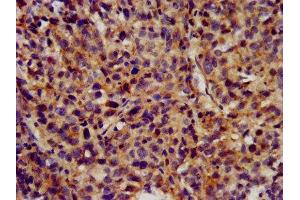 IHC image of ABIN7163969 diluted at 1:300 and staining in paraffin-embedded human ovarian cancer performed on a Leica BondTM system. (KCNC3 抗体  (AA 638-745))