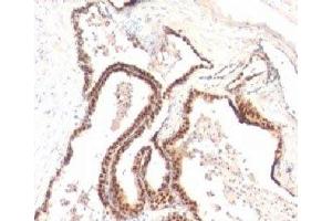 Formalin-fixed, paraffin-embedded human prostate cancer stained with p27Kip1 antibody (KIP1/769) (CDKN1B 抗体)