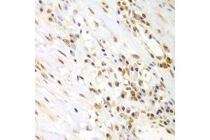 Immunohistochemistry of paraffin-embedded human gastric cancer using LHX4 antibody at dilution of 1:100 (x400 lens). (LHX4 抗体)