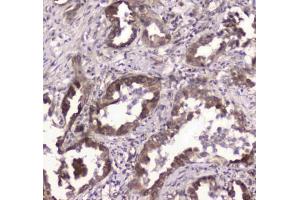 IHC testing of FFPE human lung cancer tissue with GLO1 antibody at 1ug/ml. (GLO1 抗体)
